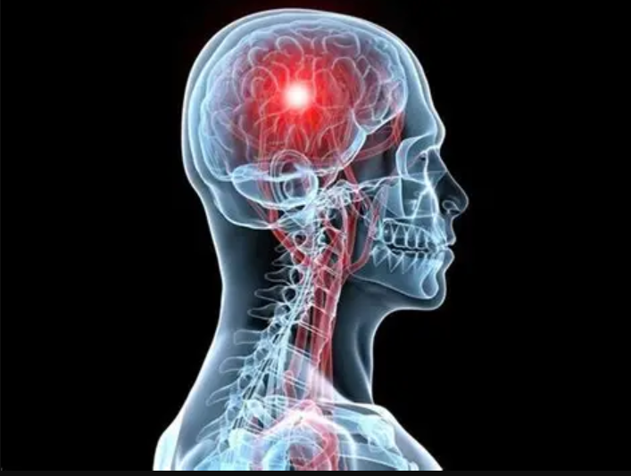 ما هي أعراض الإصابة بالجلطة وطرق الوقاية منها؟