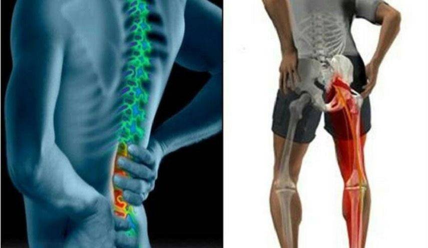 يسبب "الألم المُشع".. ما هو علاج عرق النسا؟