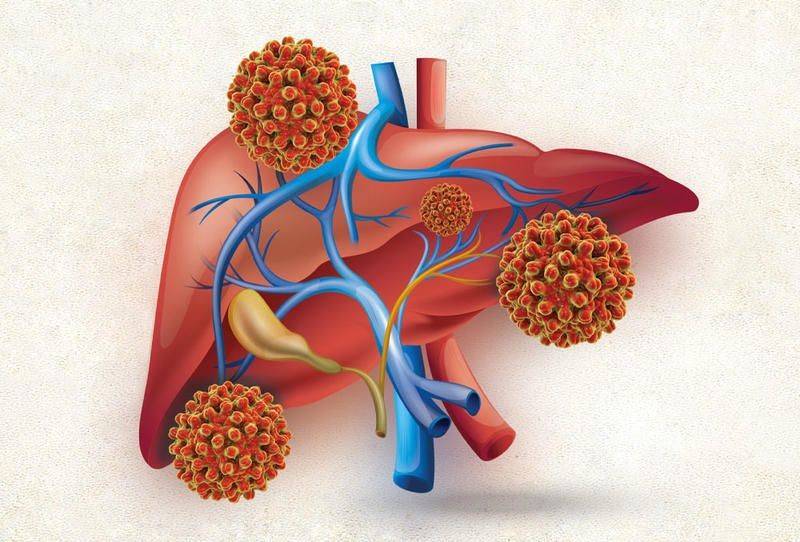 أبرزها اصفرار الجلد وبياض العينين.. ما هي علامات التهاب الكبد؟