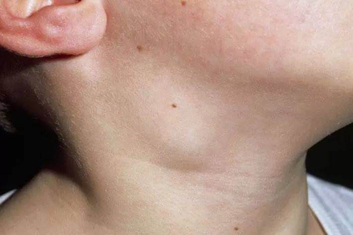 أهمها داء خدش القطة أو عدوى فيروسية.. أسباب انتفاخ الغدد اللمفاوية في الرقبة