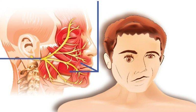 يسبب شلل نصف الوجه.. ما هو التهاب العصب السابع؟
