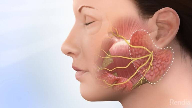 يسبب شلل نصف الوجه.. ما هو التهاب العصب السابع؟
