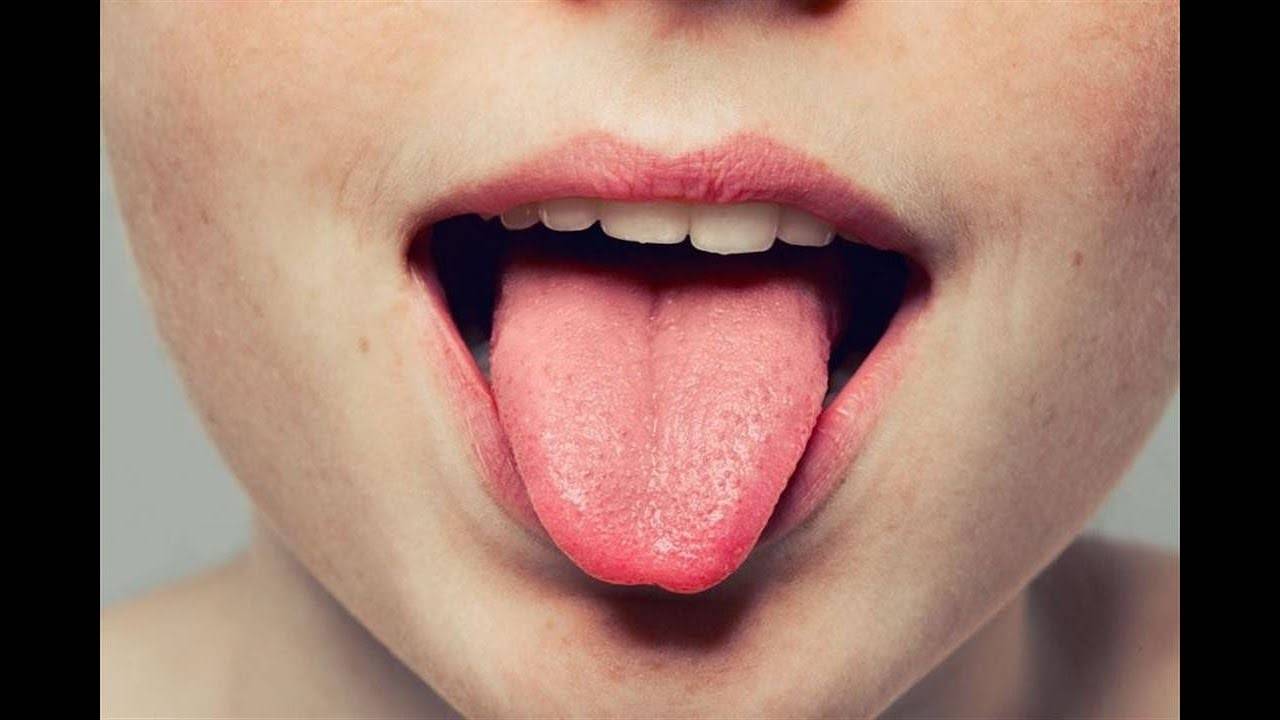 ما هو علاج التهاب اللسان؟