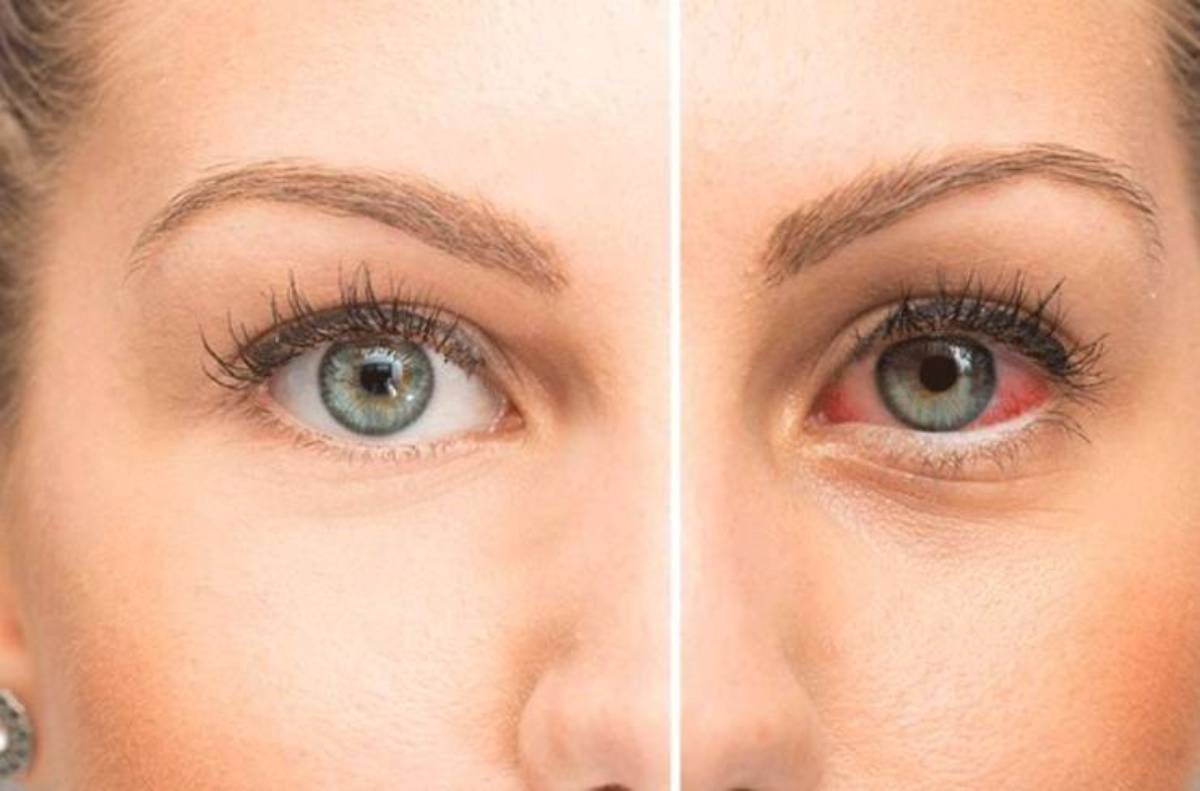 ما أسباب جفاف العين وكيف يمكن علاجه بفعالية؟