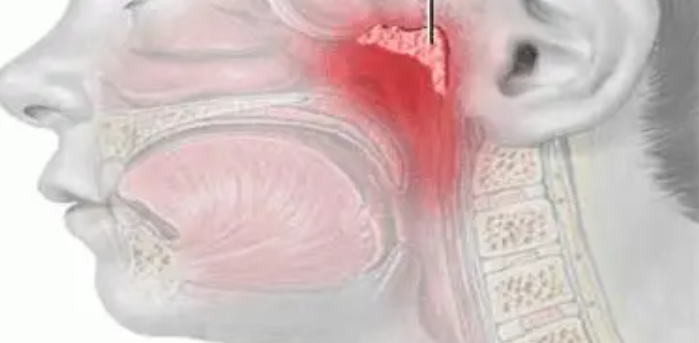ما هي أسباب تضخم اللحمية وطرق علاجها؟