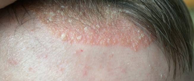 ما هي أكزيما الشعر.. وكيف يمكن علاجها؟