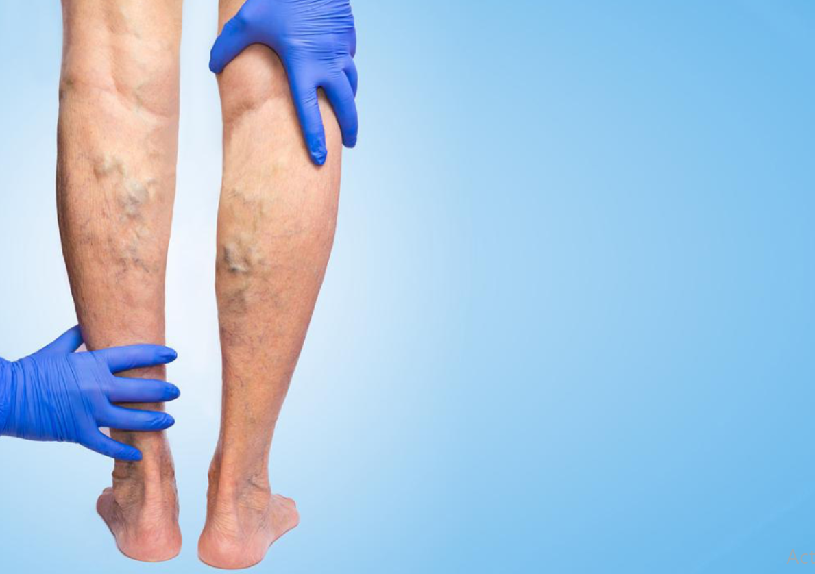 أسباب شائعة للإصابة بـ دوالي الساقين.. احذرها