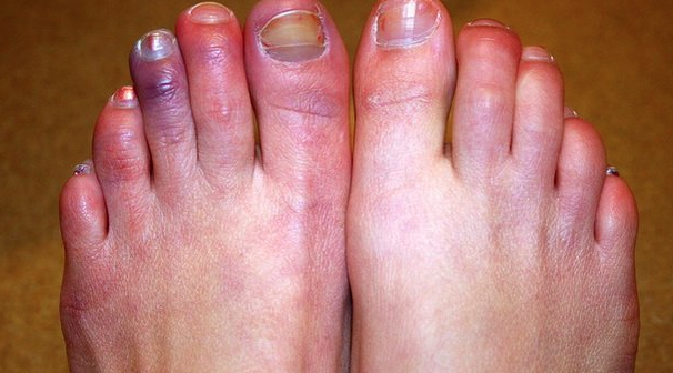 ما هي أسباب برودة الأطراف؟