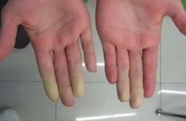 ما هي أسباب برودة الأطراف؟