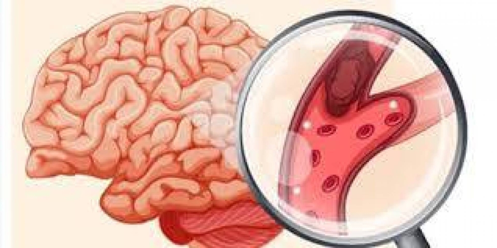 ما هي أنواع الجلطة الدماغية وطرق علاجها؟