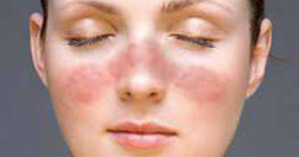 الذئبة الحمراء.. عندما يفقد الجهاز المناعي قدرته على التمييز