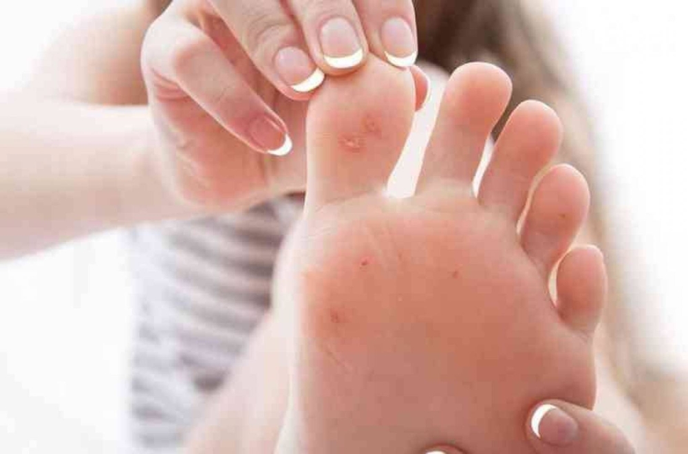 ما هو علاج مسمار القدم؟ وهل يحتاج التدخل الجراحي؟