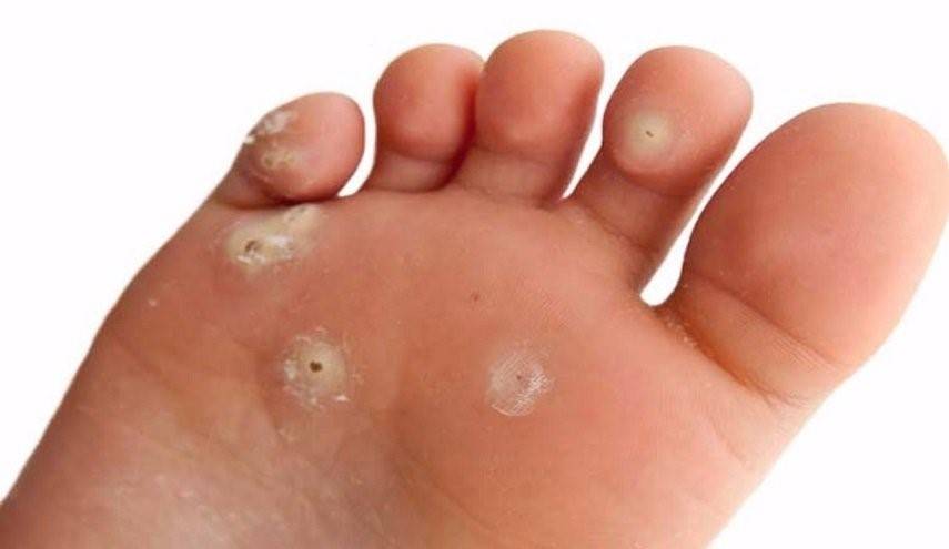 ما هو علاج مسمار القدم؟ وهل يحتاج التدخل الجراحي؟