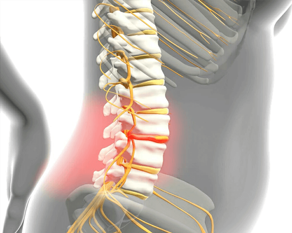 كيف تعرف أنك مصاب بالانزلاق الغضروفي؟ وما الخيارات المتاحة للعلاج؟