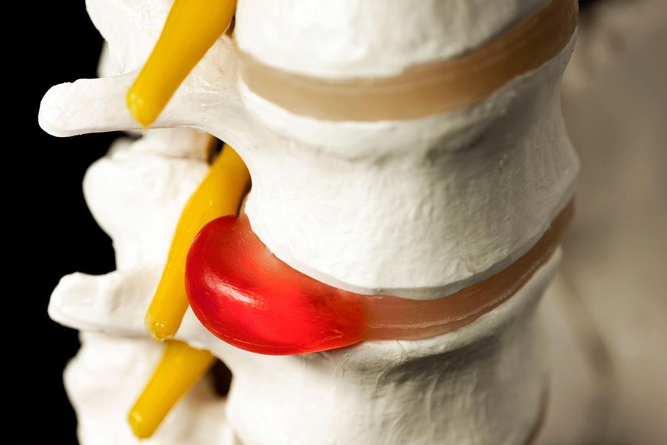 كيف تعرف أنك مصاب بالانزلاق الغضروفي؟ وما الخيارات المتاحة للعلاج؟