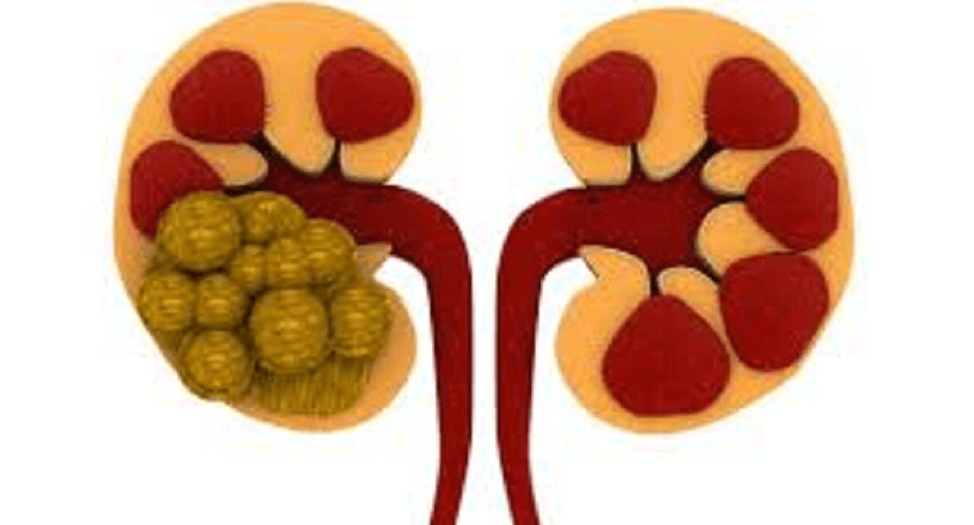 هل تعاني من ألم مفاجئ في جانبك؟.. تعرف على أسباب وأخطار حصوات الكلى