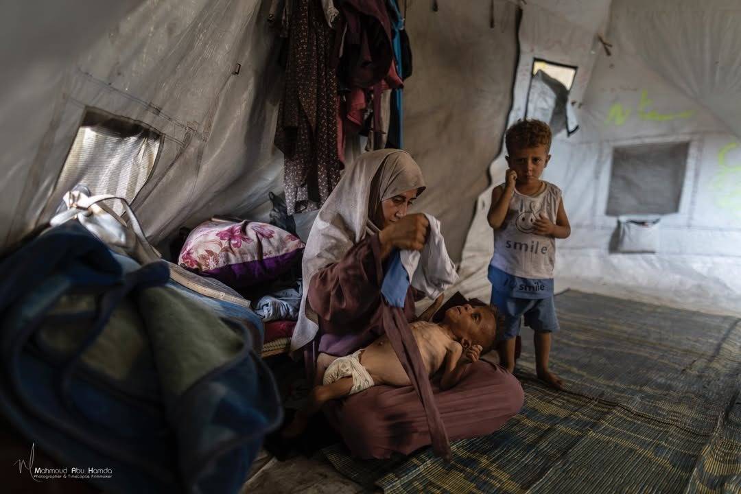 الطفل محمد المطوق يصارع الموت جوعاً في غزة بوزن 6 كيلوغرامات