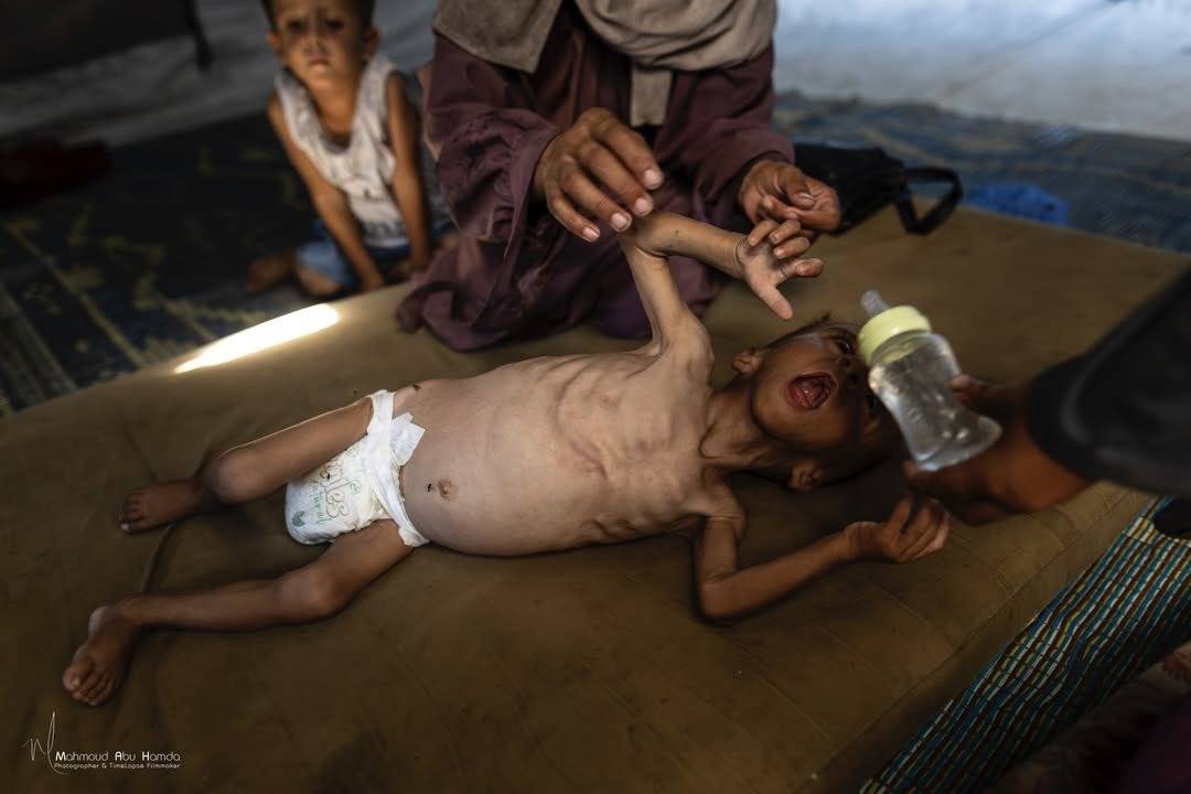 الطفل محمد المطوق يصارع الموت جوعاً في غزة بوزن 6 كيلوغرامات