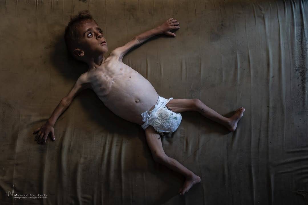 الطفل محمد المطوق يصارع الموت جوعاً في غزة بوزن 6 كيلوغرامات