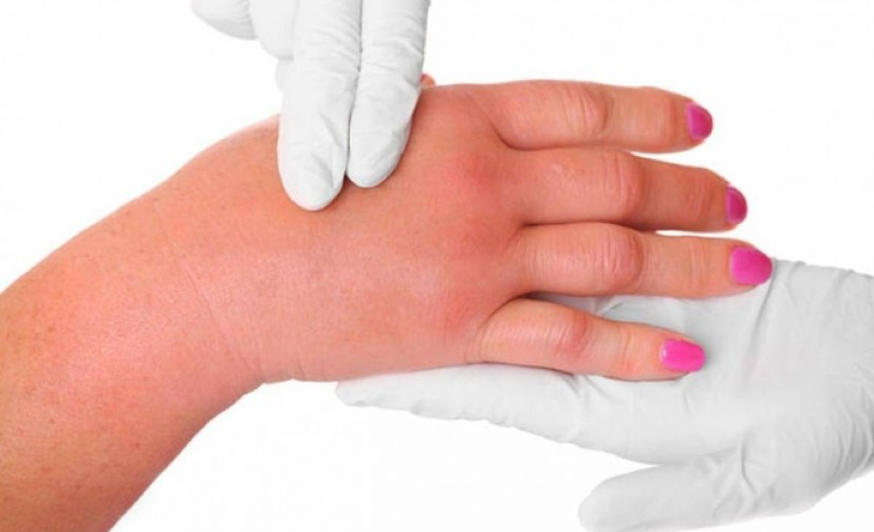 أبرزها أمراض الكبد.. أسباب احتباس السوائل في الجسم