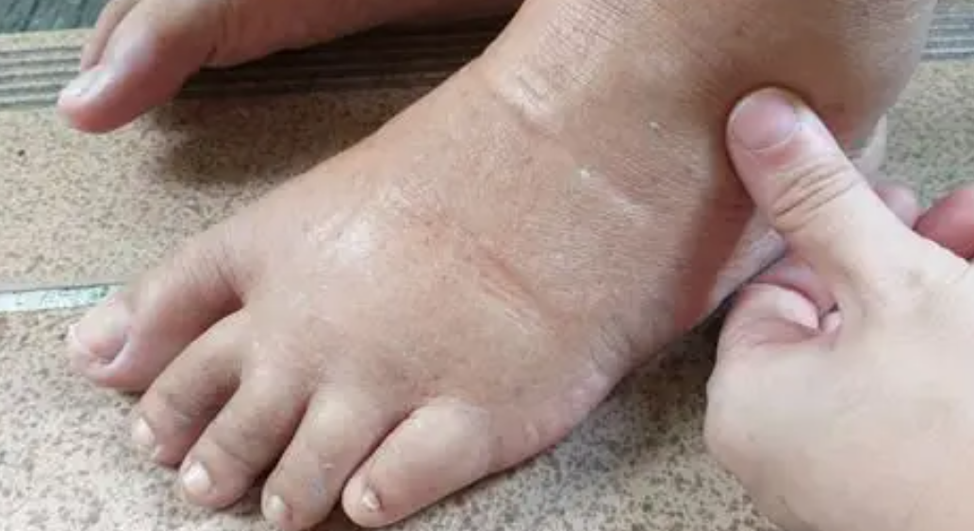 أبرزها أمراض الكبد.. أسباب احتباس السوائل في الجسم