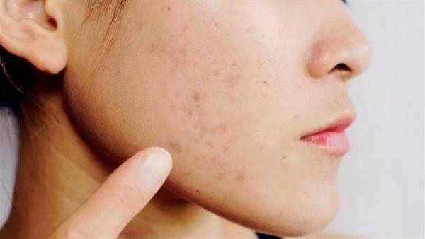 نصائح فعالة للتخلص من آثار الحبوب واستعادة نضارة البشرة