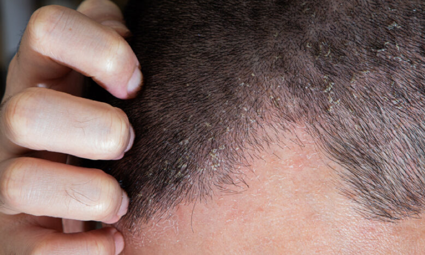 5 وصفات طبيعية تقلل من حكة الشعر وتهيج فروة الرأس