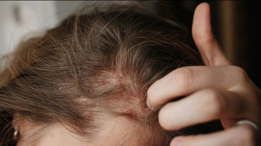 5 وصفات طبيعية تقلل من حكة الشعر وتهيج فروة الرأس