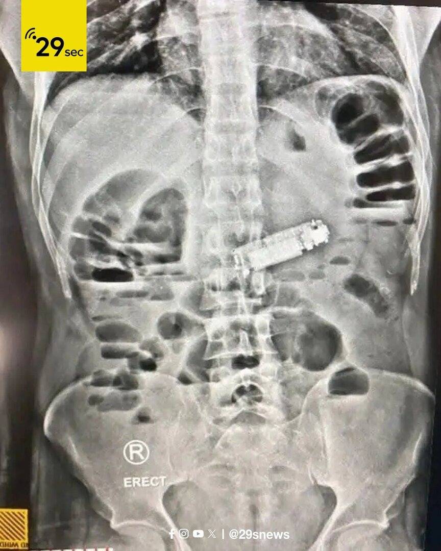 فريق طبي مصري يستخرج هاتفا من معدة مريض