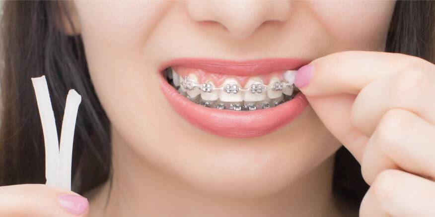 نصائح فعالة للتخفيف من آلام تقويم الأسنان