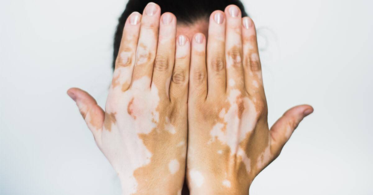 هل البهاق من الأمراض المعدية؟