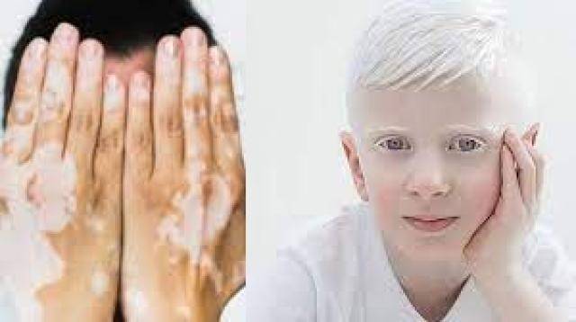 هل البهاق من الأمراض المعدية؟