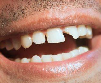 كيفية التعامل مع إصابات الأسنان.. دليل الإسعافات الأولية