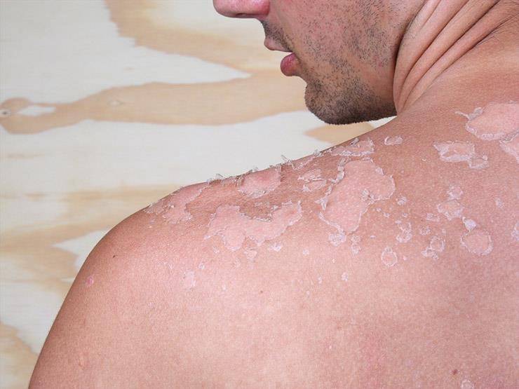 حروق الشمس.. كيف تحمي بشرتك وتتعامل معها؟