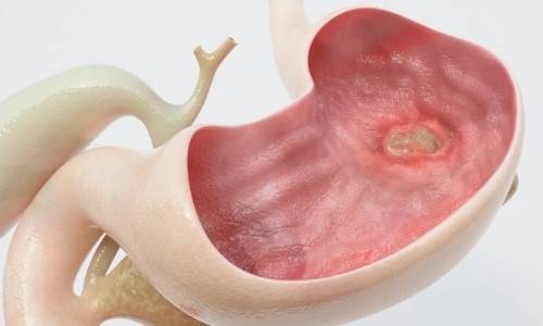 أعراض قرحة المعدة.. 9 علامات لا يجب تجاهلها