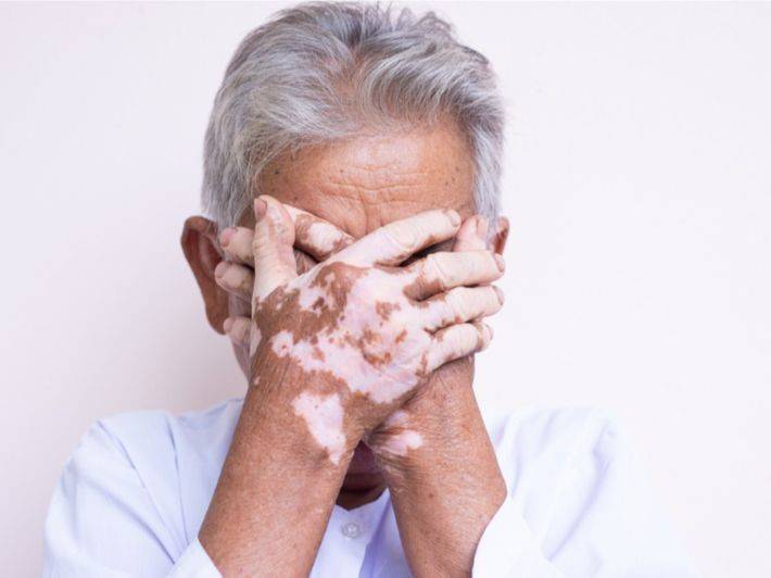 هل تعاني من تصبغ جلدك؟ وما هو البهاق البهاق؟