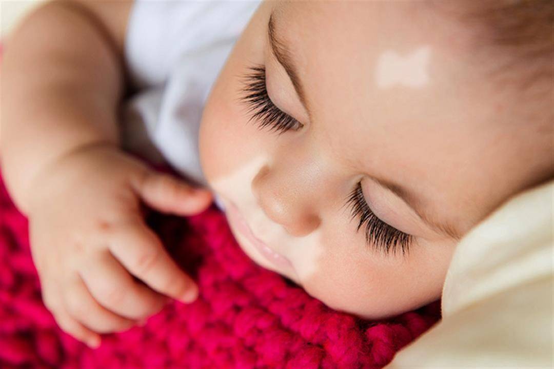 هل تعاني من تصبغ جلدك؟ وما هو البهاق البهاق؟