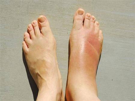 كيف أتخلص من احتباس السوائل في الجسم؟