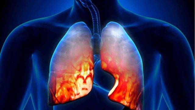 4 نصائح تساعد مرضى الالتهاب الرئوي على التعافي السريع