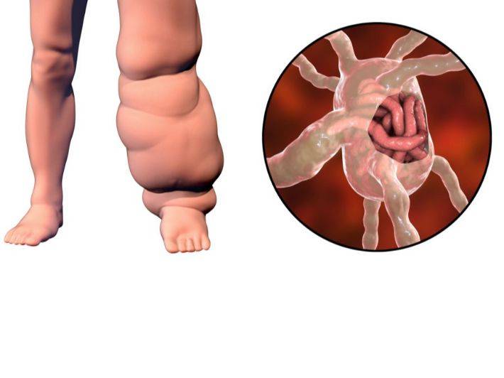 كل ما تحتاج معرفته عن داء الفيل.. لماذا يعد من أخطر الأمراض الطفيلية؟