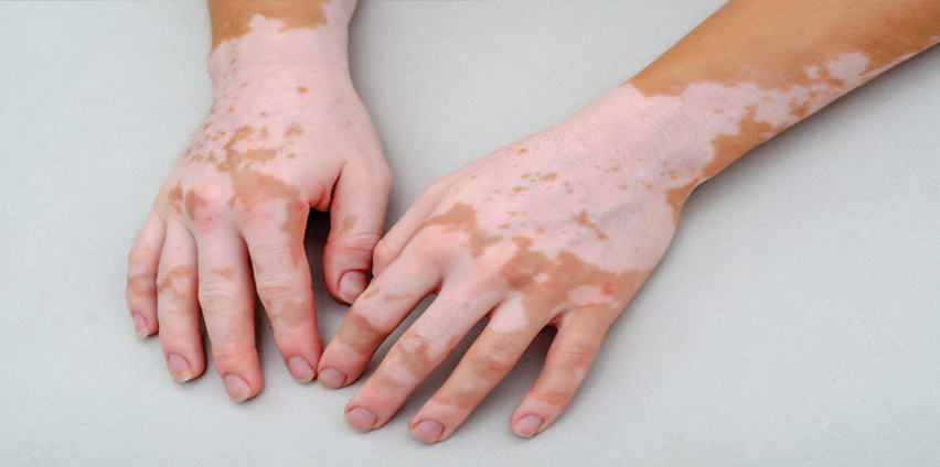 هل يمكن الشفاء من البهاق نهائيًا؟ الحقائق الكاملة