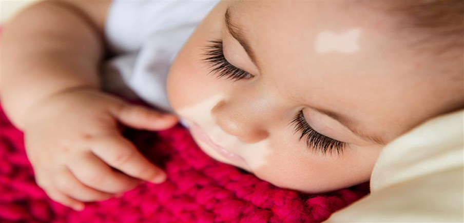 هل يمكن الشفاء من البهاق نهائيًا؟ الحقائق الكاملة