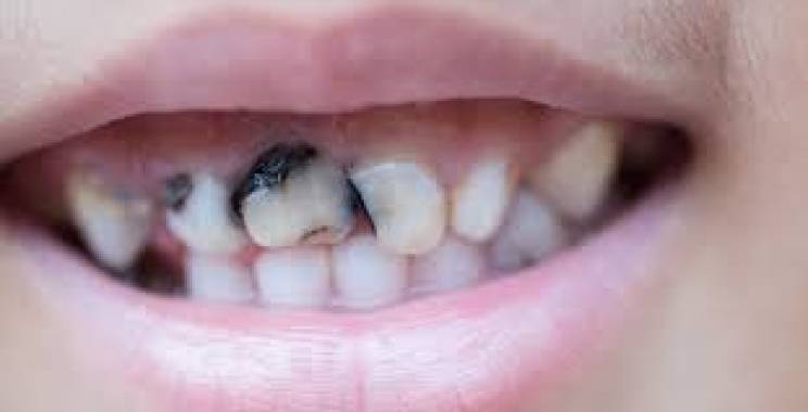 عادات يومية تحمي أسنانك من التسوس وتحافظ على ابتسامتك.. احرص عليها