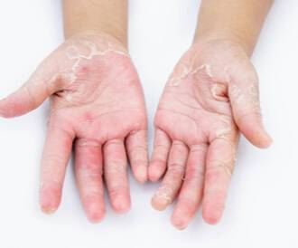 كيف تتجنب الطفح الجلدي وحروق الشمس في الصيف؟