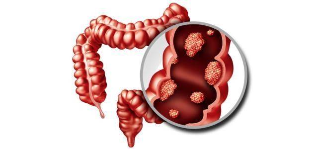 أمراض الجهاز الهضمي وعلاقتها بالطعام.. كيف نحافظ على صحة أمعائنا؟
