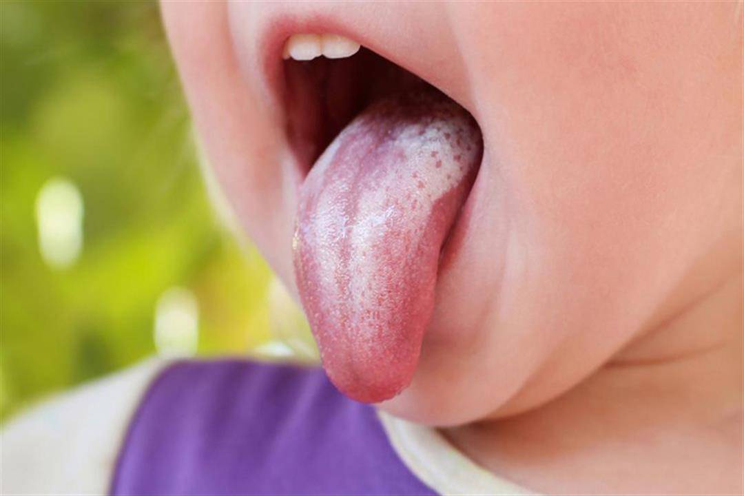 هذا ما يخبرك به لون لسانك عن صحتك