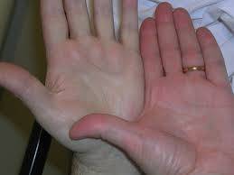 أسباب الإصابة بفقر الدم.. وطرق العلاج