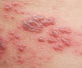 أعراض مرض الهربس وطرق الوقاية منه