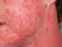 أعراض مرض الهربس وطرق الوقاية منه