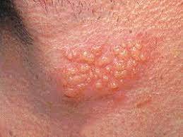 أعراض مرض الهربس وطرق الوقاية منه